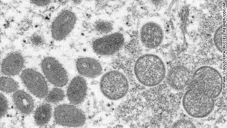 The Centers for Disease Control and Prevention is monitoring 6 people in the United States for possible monkeypox, but says the public shouldn't be concerned.